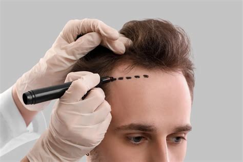 Haartransplantatie Trends Voor 2024