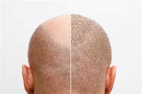 De Belangrijke Tips Voor Een Succesvolle Haartransplantatie