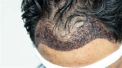 Haartransplantatie: Een Stap Voor Stap Gids