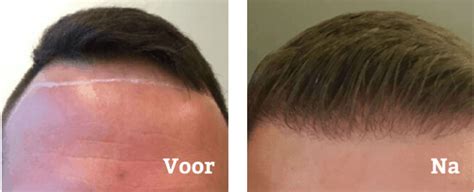 Haartransplantatie En De Impact Op Jezelfvertrouwen