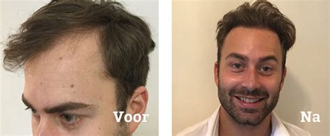 Haartransplantatie Experts Delen Hun Ervaringen