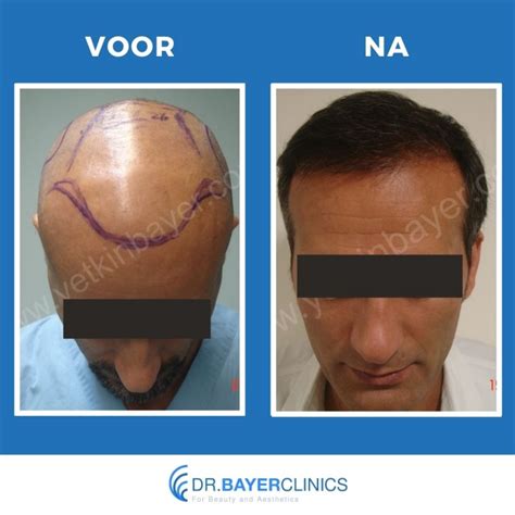 Haartransplantatie Voor En Na: Foto’s Van Succesverhalen