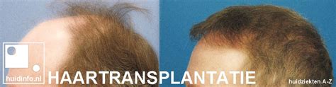 Zorg Voor Je Haar Na Een Transplantatie