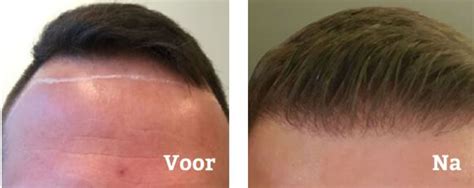 Haartransplantatie: Wanneer Is Het Tijd Om Te Overwegen?