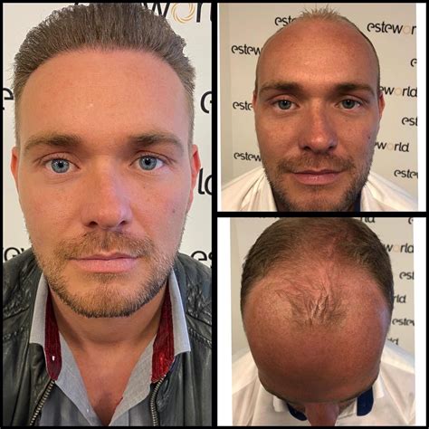 Klantervaringen Met Haartransplantatie: Testimonials