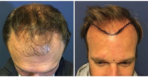 Top 5 Misverstanden Over Haartransplantatie