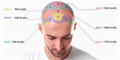 Haartransplantatie Kosten In Detail: Een Transparante Analyse