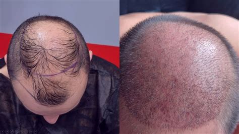 Zorg Na Haartransplantatie: Tips Voor Optimale Herstel