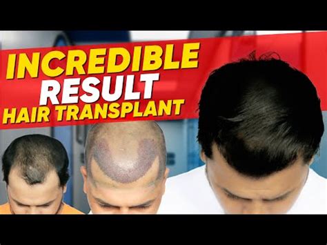 Haartransplantatie In Nederland: Wat Je Moet Weten