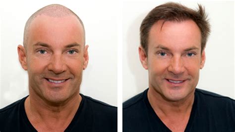 Haartransplantatie: Voor En Na Resultaten