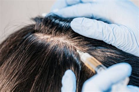 Kiezen Tussen Een PRP Behandeling Of Haartransplantatie