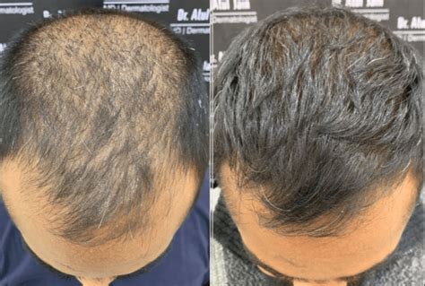PRP En Haartransplantatie: Een Krachtig Duo